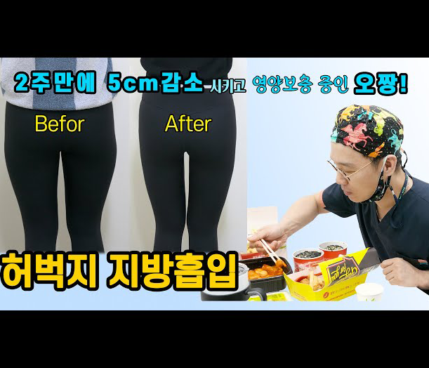 허벅지 지방흡입